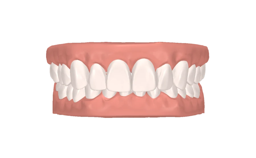 Upper jaw protrusion treatment simulation, stage 1