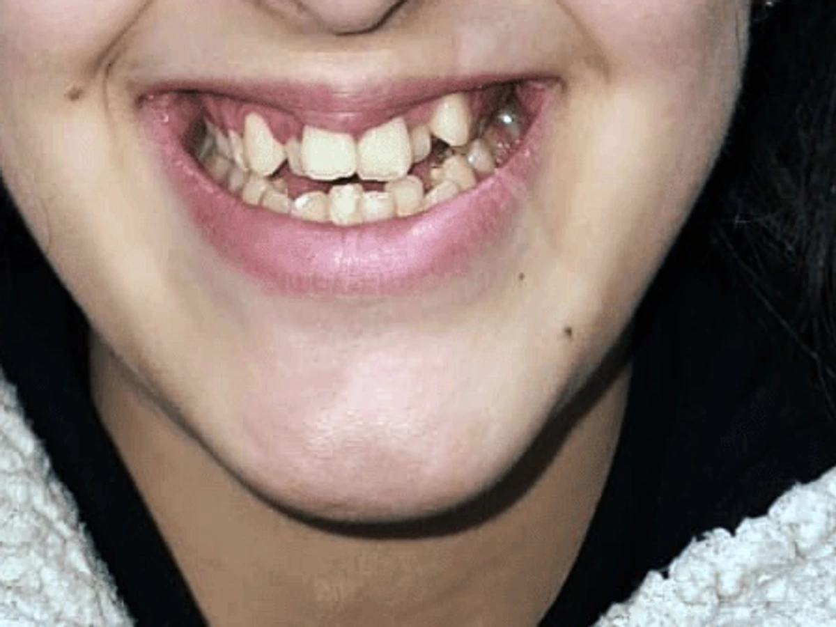 Orthodontic treatment result smile before