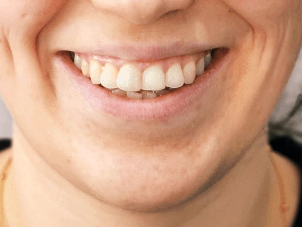 Personalized treatment result smile before