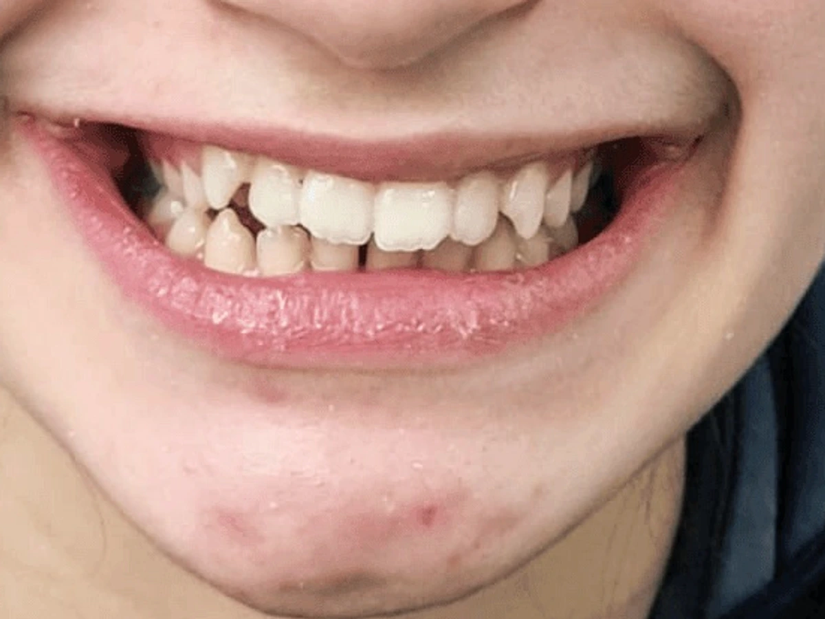 Tooth alignment treatment result smile before